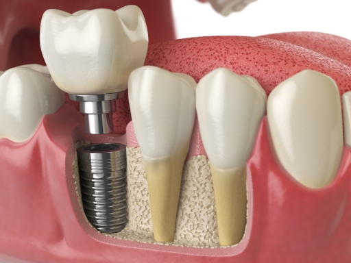 tooth dental implant by Vashon dentist