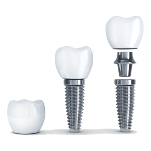 Dental-implants-illustration with dentist in Vashon