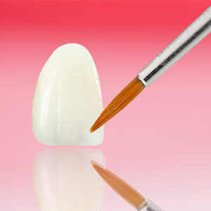 Fluoride-Treatment-Ilustration at Dental Care of Vashon