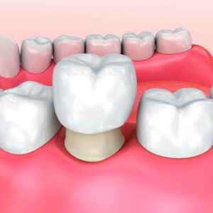 dental-crowns with our dentist in Vashon