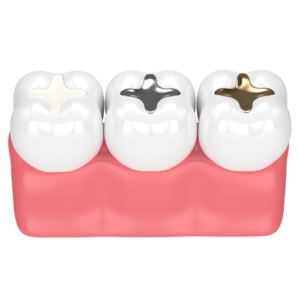 Fillings - Dental Implants