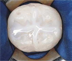 Sealant applied dental care in Vashon