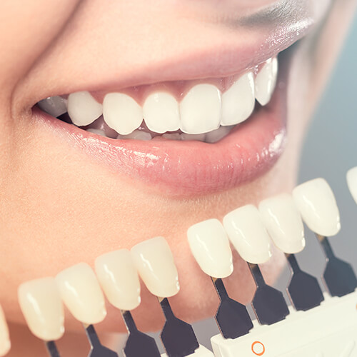 white-teeth-treatment by dental care of Vashon