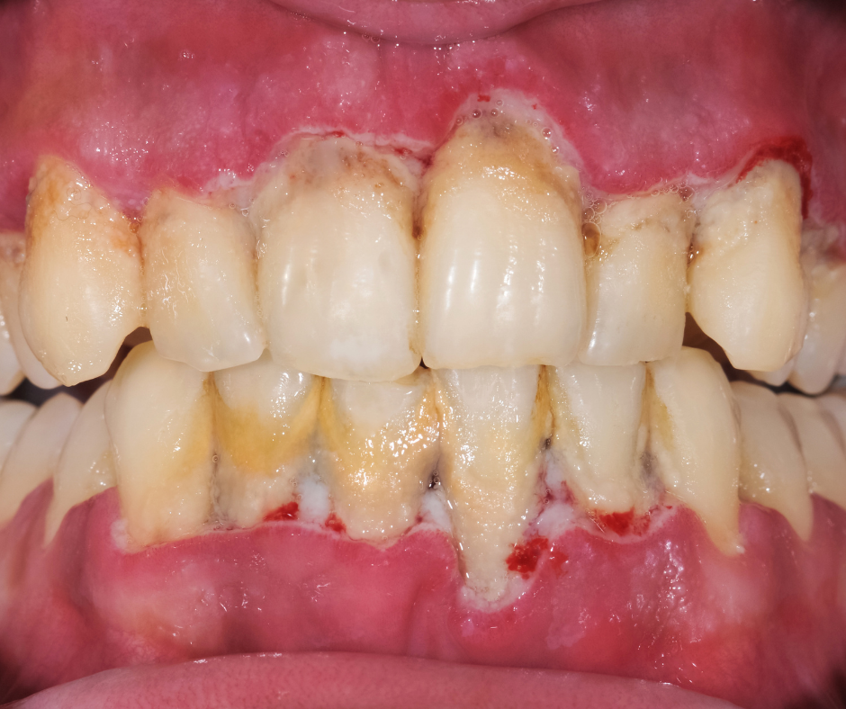 periodontal-disease-1